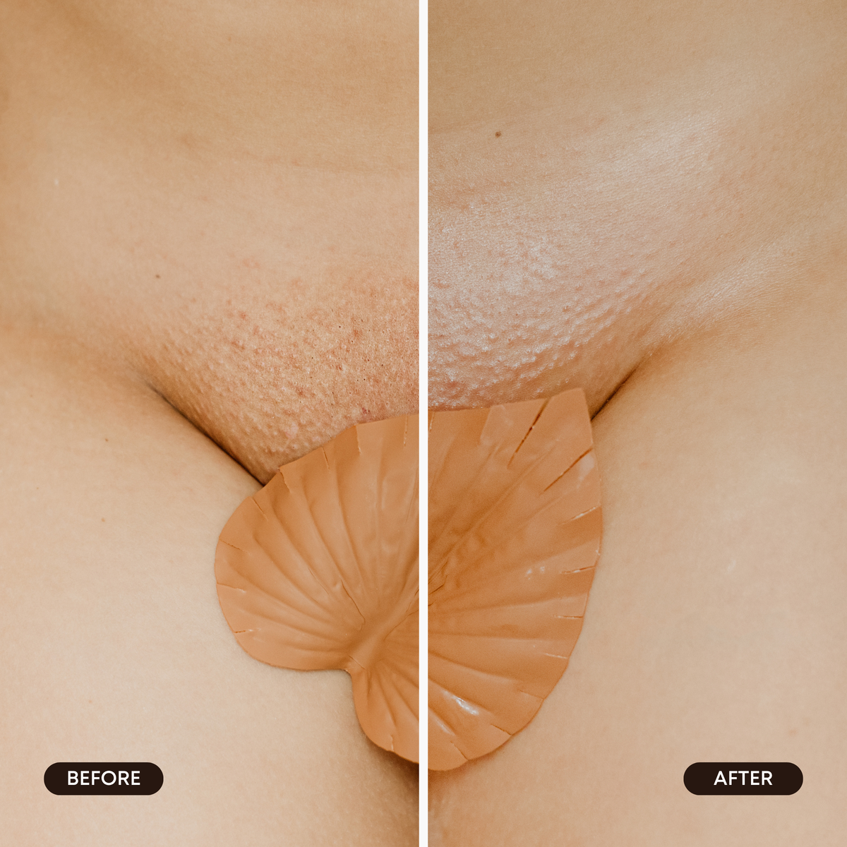 Hydrogel Vajacial Side Strips