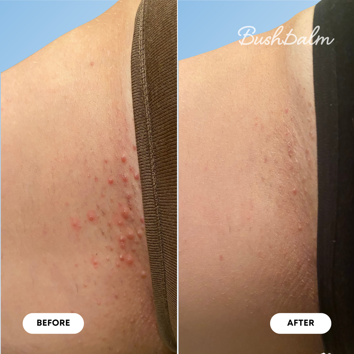 Ingrown Hair Oil - Nude