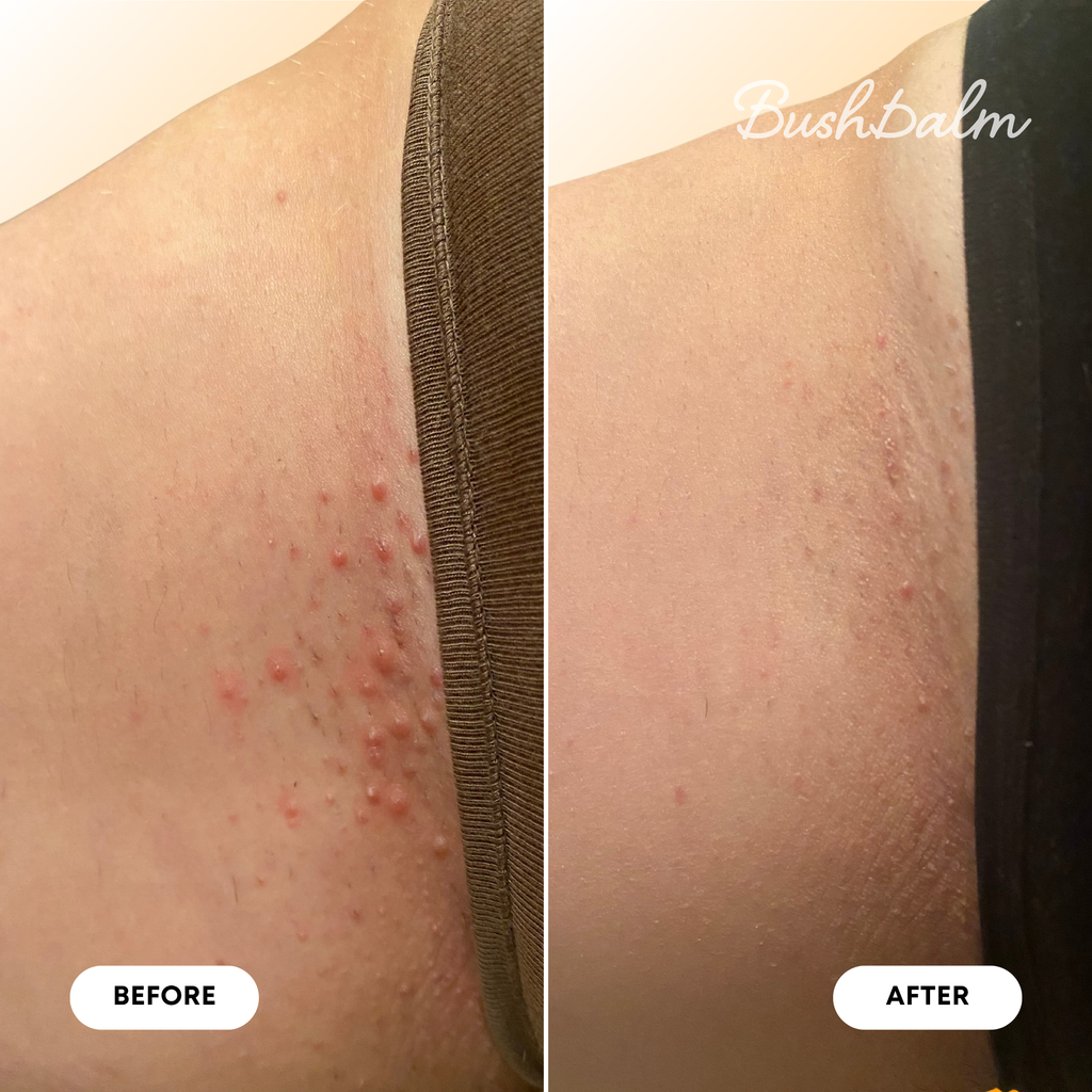 Ingrown Hair Oil - Vanilla Tangerine