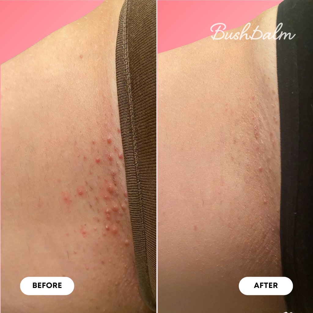 Ingrown Hair Oil - Watermelon Sugar
