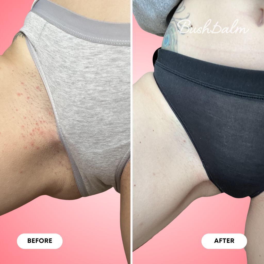 Ingrown Hair Exfoliating Scrub - Watermelon Sugar