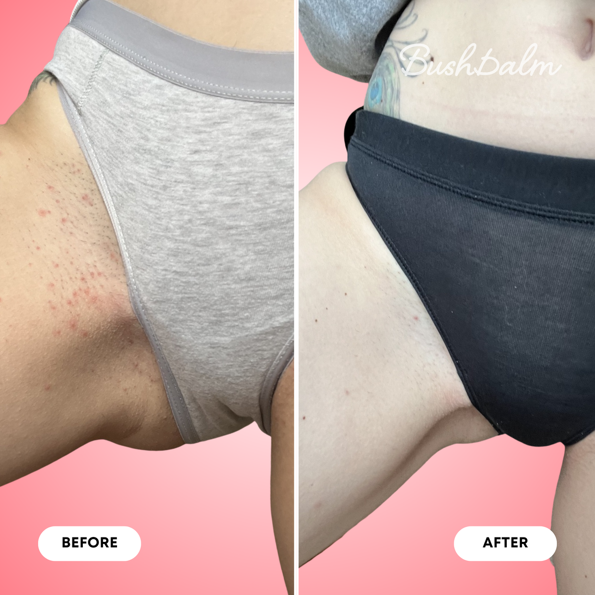 Ingrown Hair Exfoliating Scrub - Watermelon Sugar